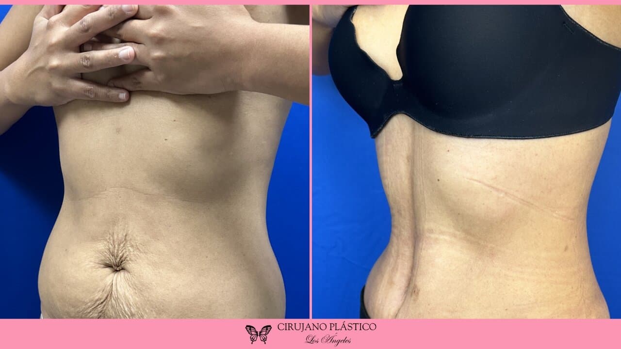 Tummy Tuck Before and After Patient 4c