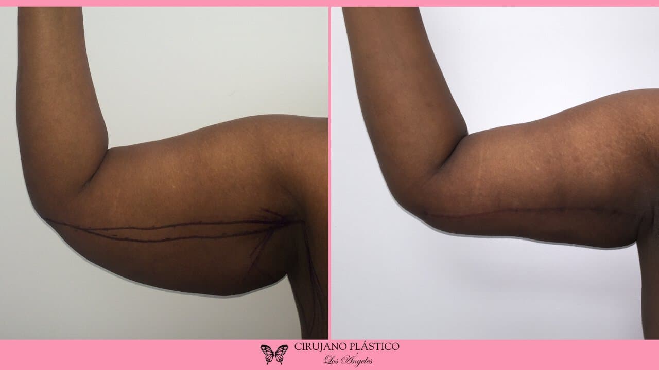 Arm Lift Before and After Patient 1a
