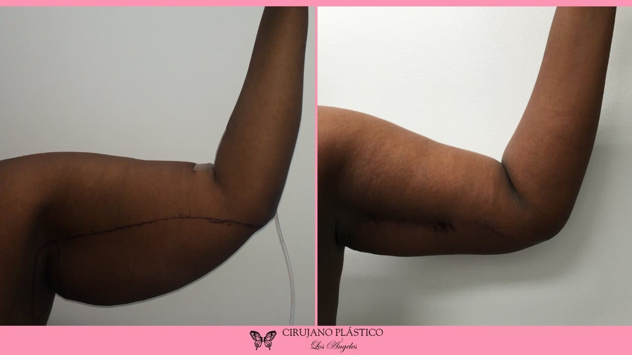 Arm Lift Before and After Patient 1b