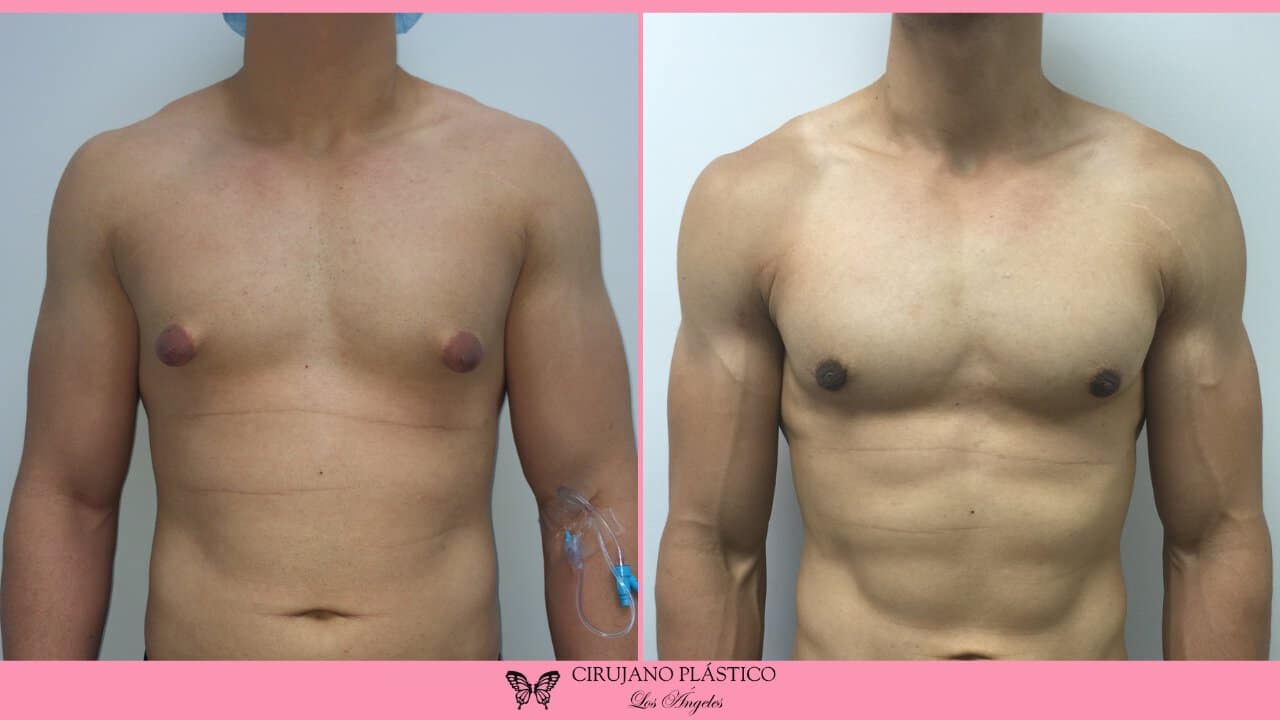 Gynecomastia Before and After Patient 1a
