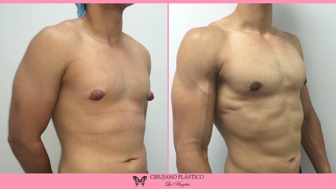 Gynecomastia Before and After Patient 1b