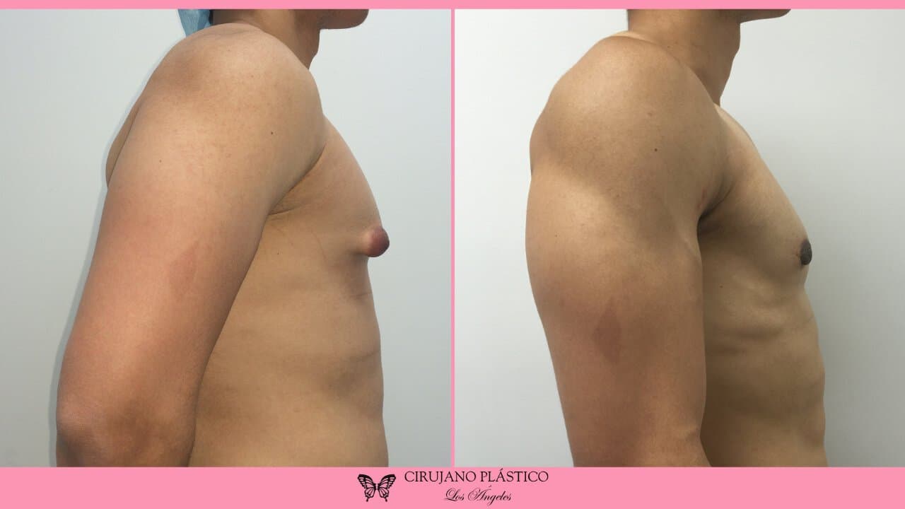 Gynecomastia Before and After Patient 1c