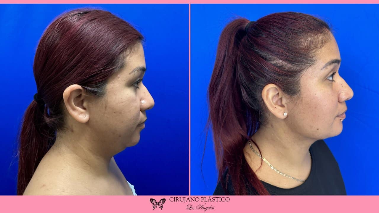 Neck Liposuction Before and After Patient 1b