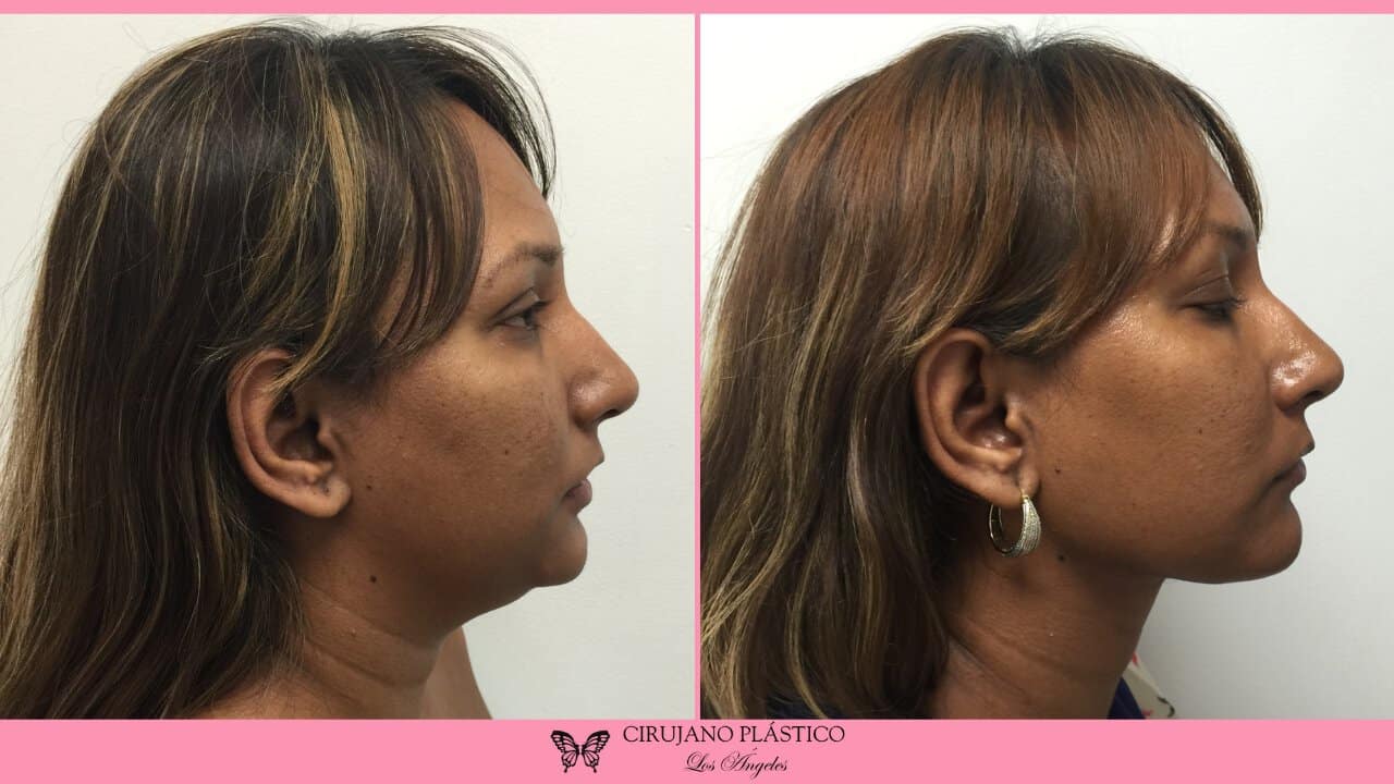 Neck Liposuction Before and After Patient 2b
