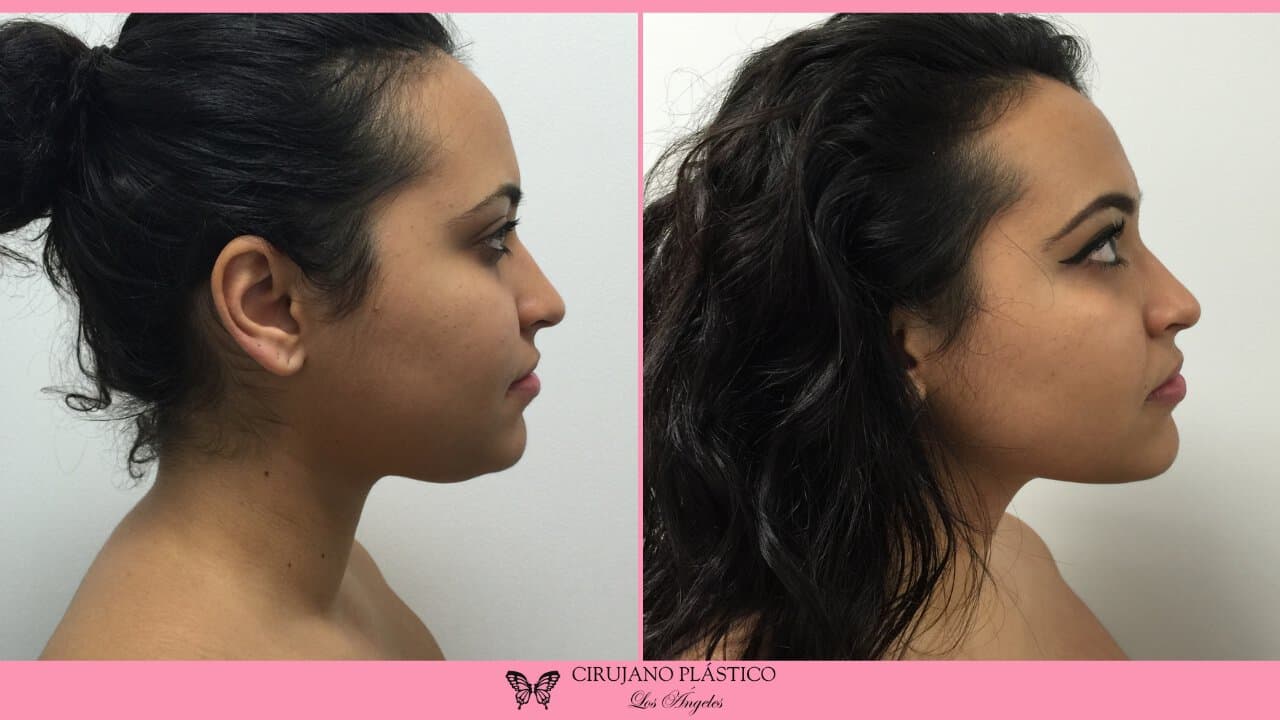 Neck Liposuction Before and After Patient 3b