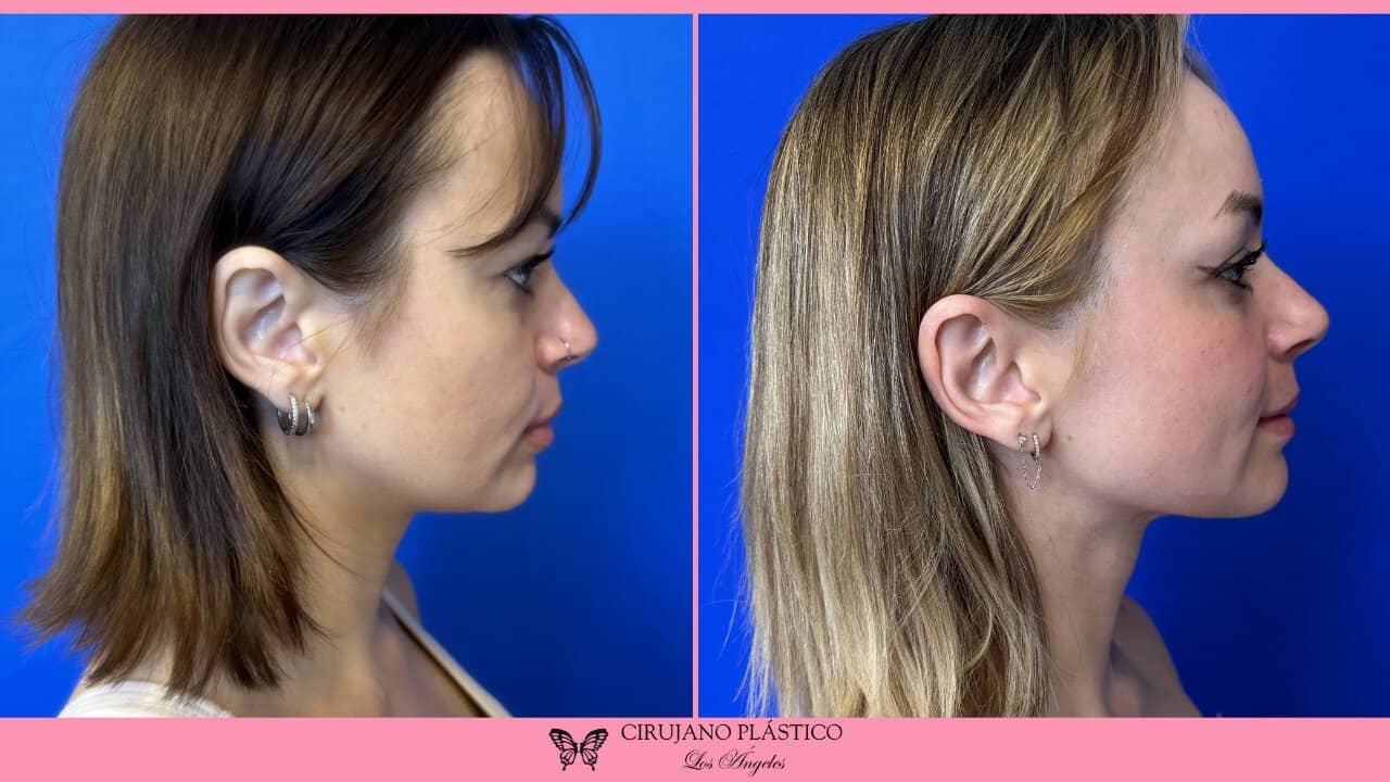 Neck Liposuction Before and After Patient 4b