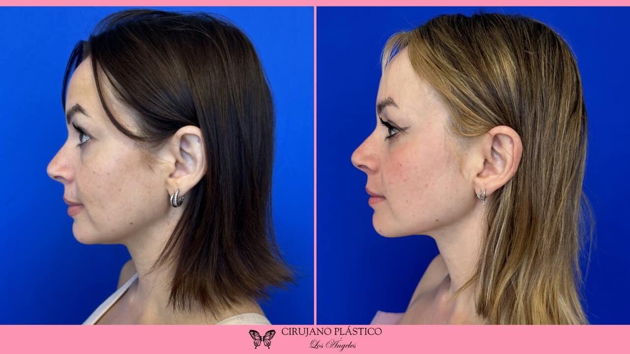 Neck Liposuction Before and After Patient 4c