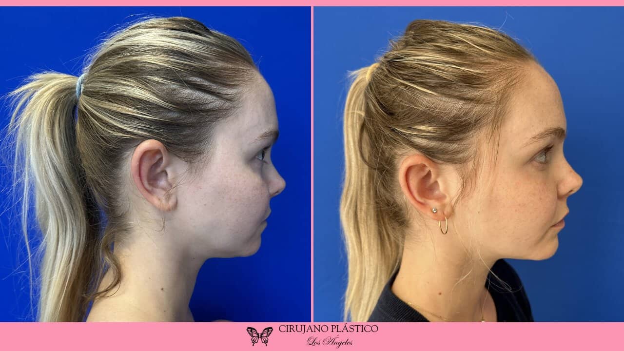 Neck Liposuction Before and After Patient 5b