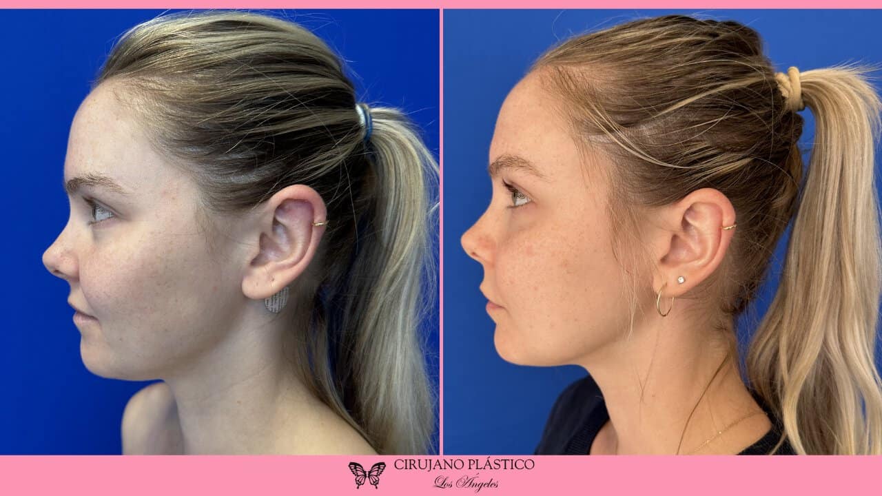 Neck Liposuction Before and After Patient 5c